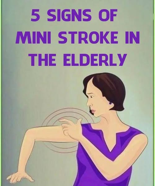Stroke: These indicators that manifest one month prior to..